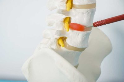 Protrusione discale e ozonoterapia
