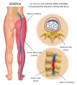 sciatica sciatalgia ozonoterapia lugano