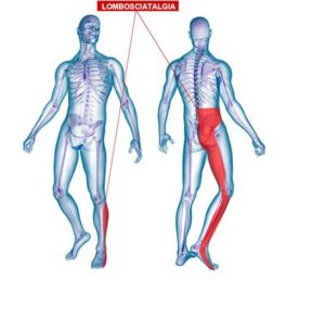 curare il mal di schiena con l'ozonoterapia