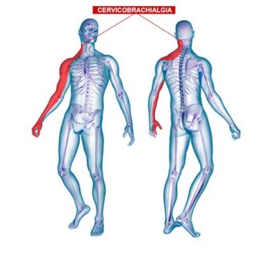 curare cervicobrachialgia con ozonoterapia lugano