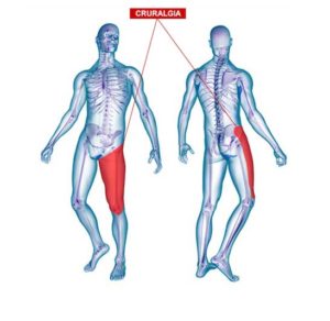 curare la cruralgia con l'ozonoterapia