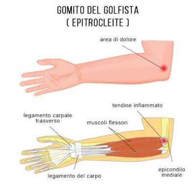 ozonoterapia cura gomito del golfista a Lugano