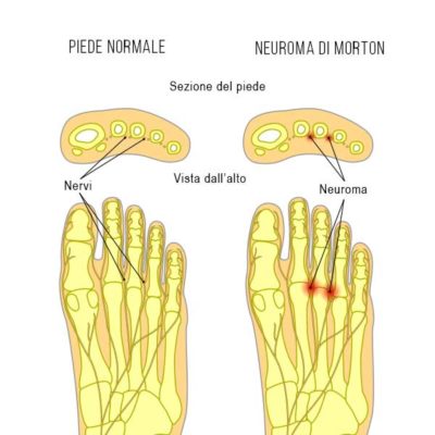 ozonotorepia per curare neuroma di morton