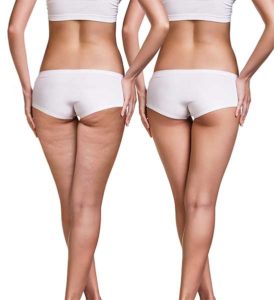 prima e dopo ozonoterapia per cellulite