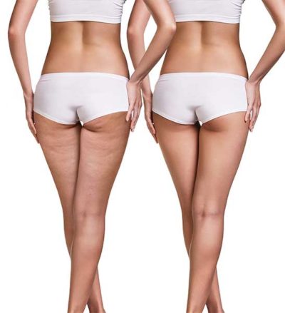 prima e dopo la terapia di ozonoterapia per cellulite