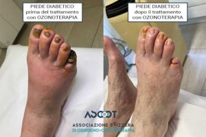 Curare-il-piede-diabetico-con-l’ozonoterapia-a-Lugano
