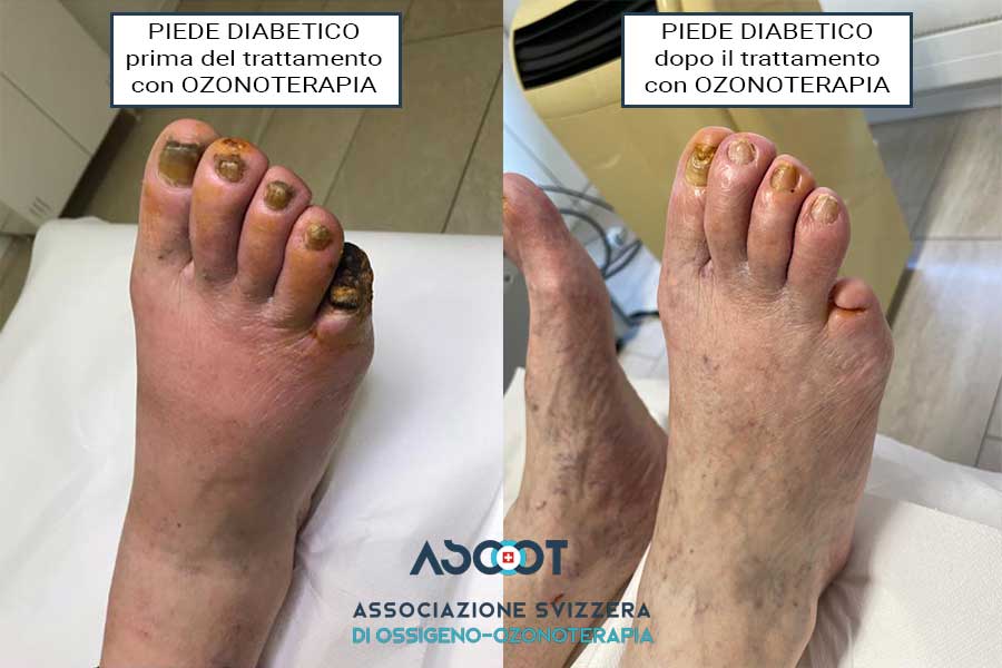 Curare-il-piede-diabetico-con-l’ozonoterapia-a-Lugano